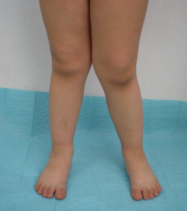 Причины и принципы терапии дисплазии коленных суставов
