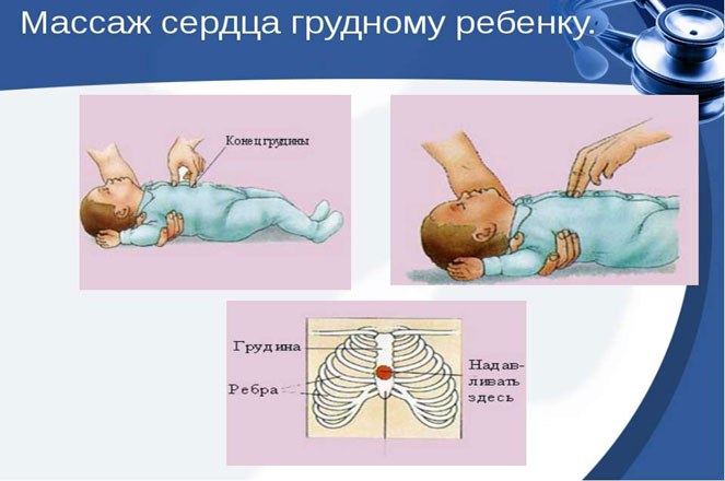 Методика непрямого массажа сердца для грудного ребенка