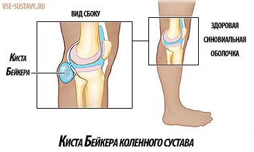 Симптомы и методы лечения кисты Бейкера коленного сустава
