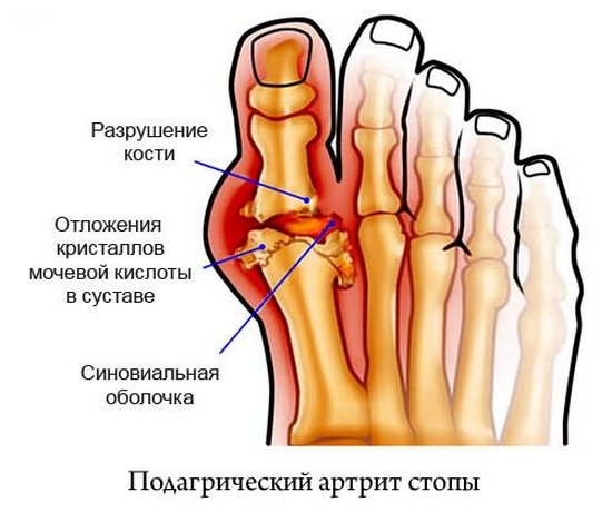 Подагрический артрит стопы