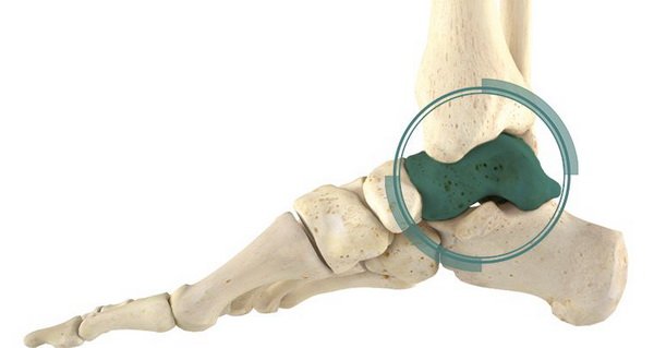 Виды и лечение переломов таранной кости