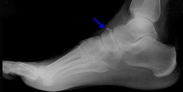 Виды и способы лечения переломов костей стопы