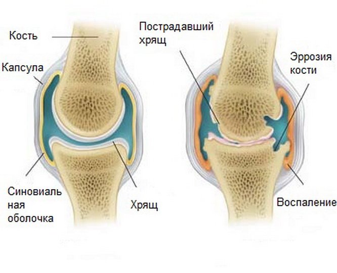 Артропатия коленного сустава у детей