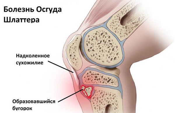 Симптомы и лечение остеохондропатии суставов