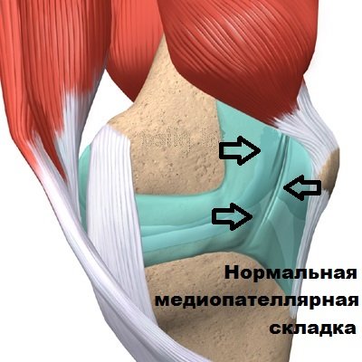 Медиопателлярная складка коленного сустава