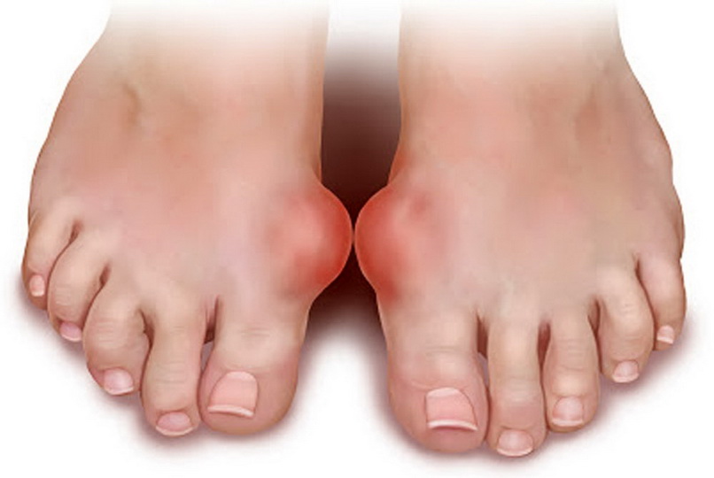 Симптомы и лечение артроза пальцев ног