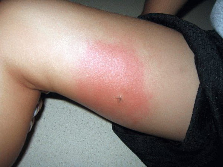 Чем лечить отек и покраснение ноги после укуса насекомого?