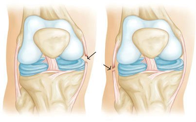 Виды и терапия повреждений связок коленного сустава
