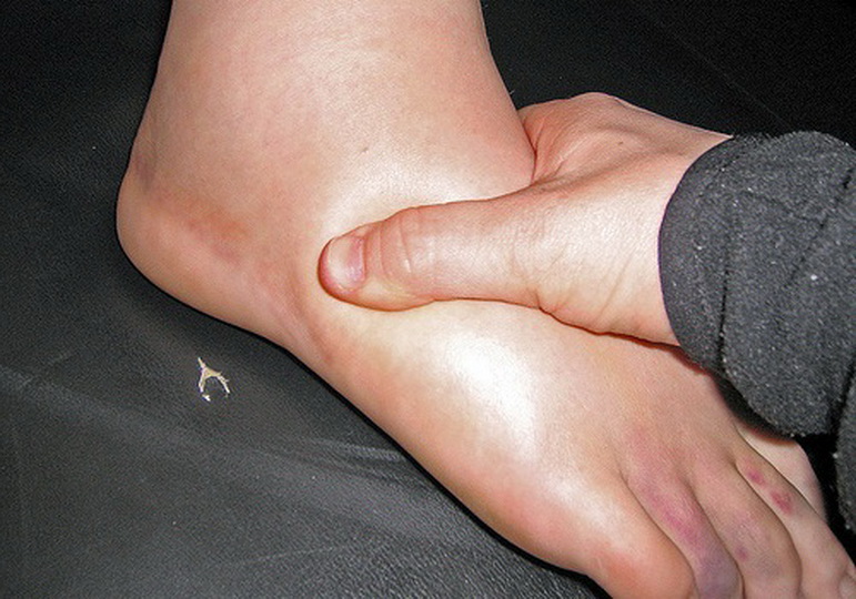Как лечить травмы, вызванные подворачиванием ноги?