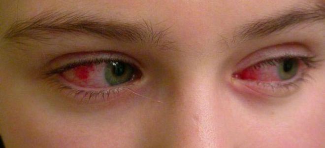 красные глаза при конъюктивите