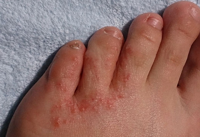 Чем лечить зуд между пальцами ног и покраснение кожи?