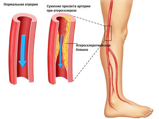 Симптомы и лечение окклюзии артерий ног