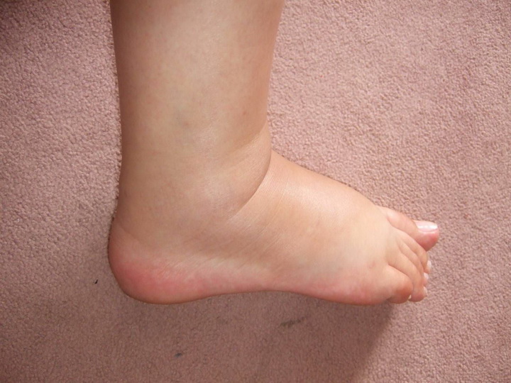 Опухают ноги ниже колен: причины отеков и лечение в домашних условиях