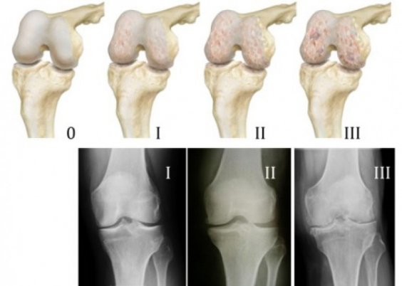 Стадии развития артрита коленного сустава