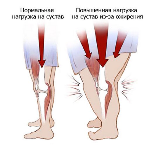 Нормальная и повышенная нагрузка на коленный сустав