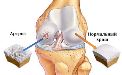 О каких патологиях сигнализирует боль в колене при нагрузке?