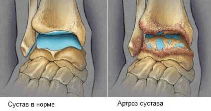 Как предотвратить артроз коленного сустава?