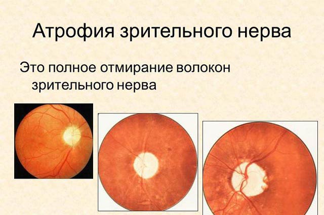 как лечить атрофию зрительного нерва
