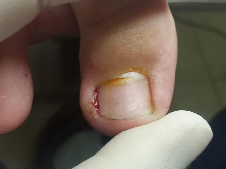 Лечение состояний, при которых палец ноги болит около ногтя
