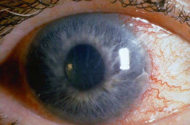 открытоугольная глаукома 1 степени