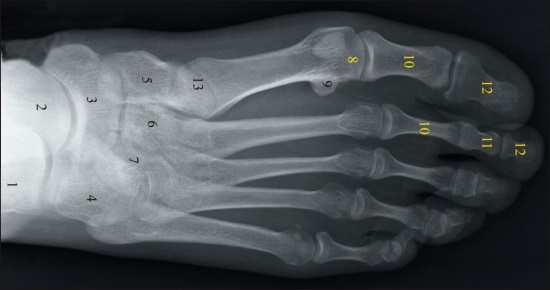 Рентгеновский снимок стопы человека