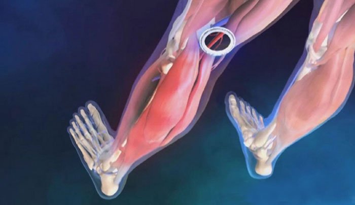 Симптомы и лечение окклюзии артерий ног