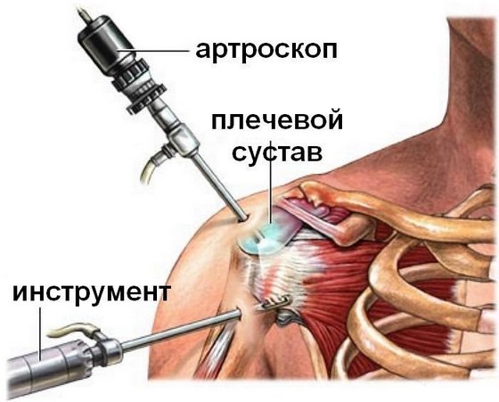 Хирургическое вмешательство в плечевой сустав 