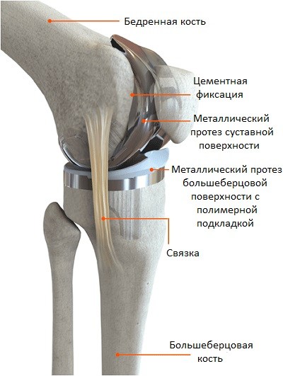 Эндоротезирование коленного сустава