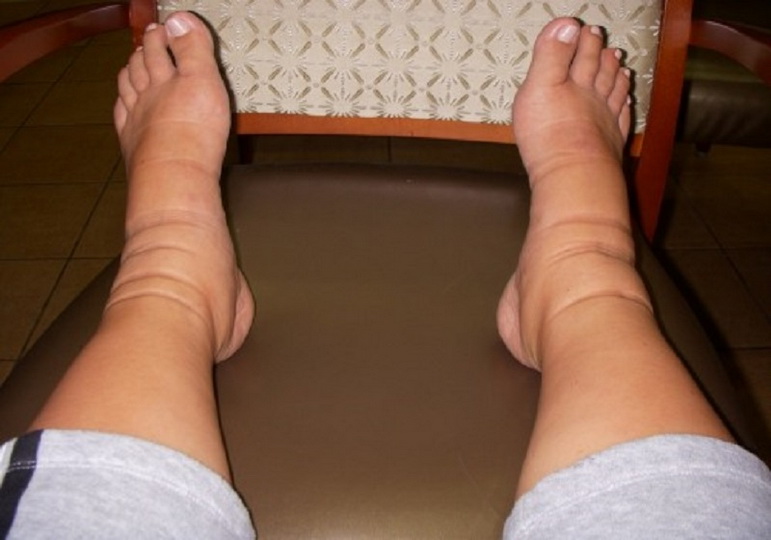 Отеки ног при варикозе, эффективное лечение в домашних условиях