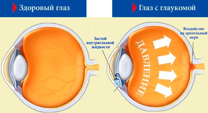 глаз с глаукомой