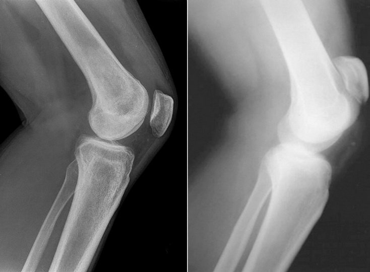 Есть ли разница между артрозом коленного сустава и гонартрозом ?