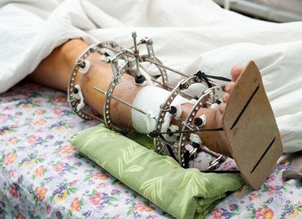 Применение аппарата Илизарова при переломе костей ног