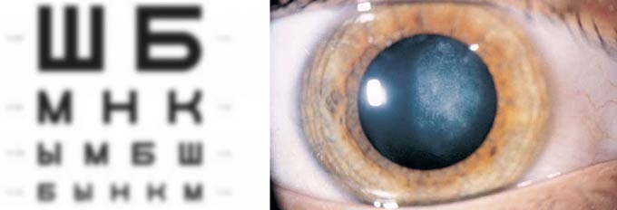 начальная стадия катаракты