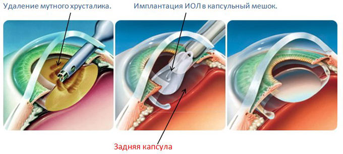 операция по удалению катаракты с заменой хрусталика