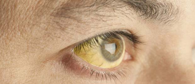 почему желтые белки глаз