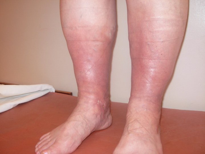 Лечение посттромбофлебитического синдрома ног