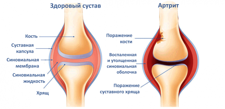Отличие артроза от артрита коленного сустава