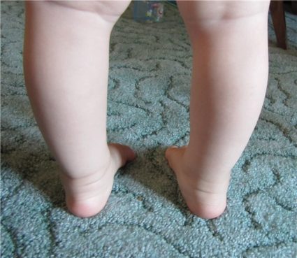 Лечение и профилактика искривления ног у ребенка