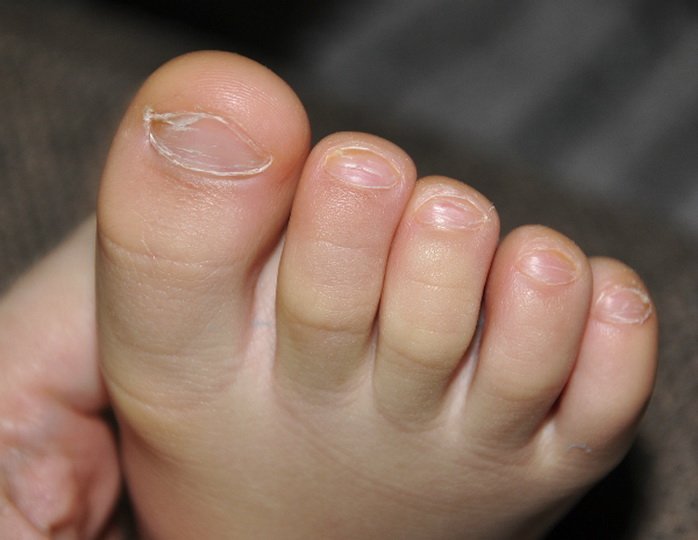 Лечение грибка ногтей у детей
