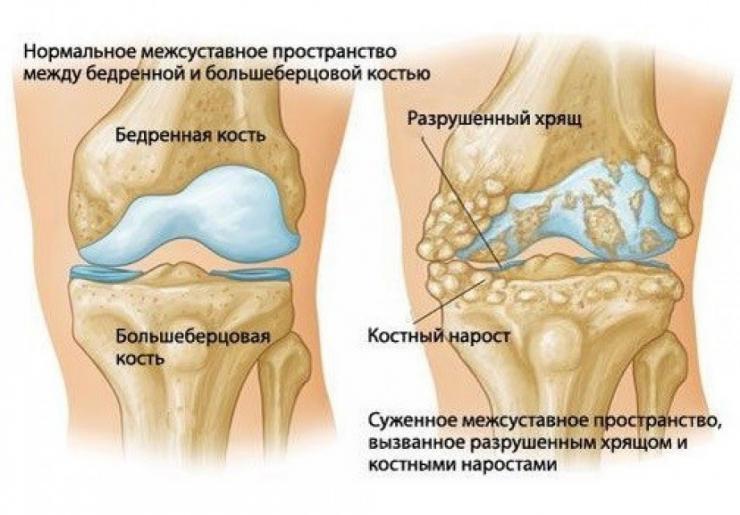 Лечение артрита и артроза коленного сустава
