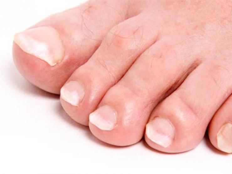Что означают белые пятна на ногтях ног?