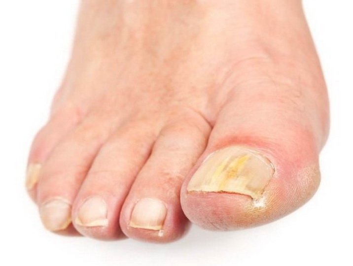 Схема терапии грибка ногтей на ногах