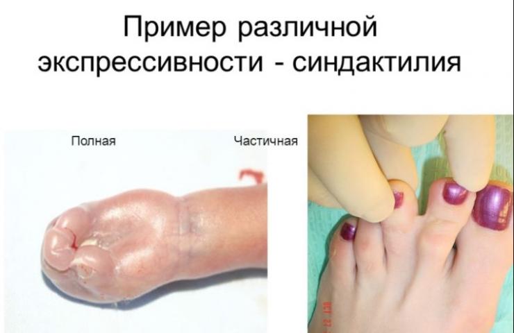 Показания к операции при синдактилии пальцев ног
