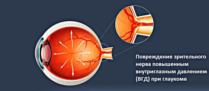 первичная открытоугольная глаукома