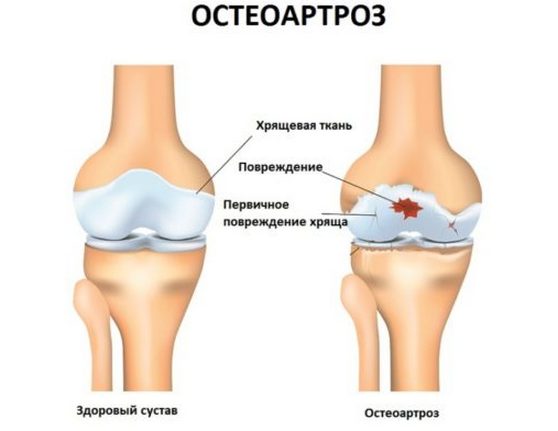Здоровый сустав и сустав, пораженный остеоартрозом