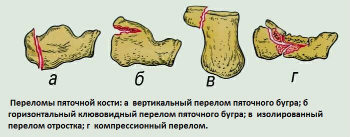 Перелом пяточной кости