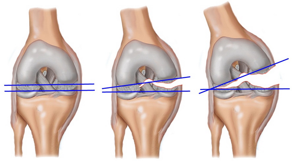 Безоперационное лечение разрывов мениска коленного сустава