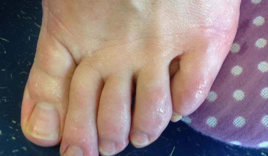 Чем лечить зуд между пальцами ног и покраснение кожи?