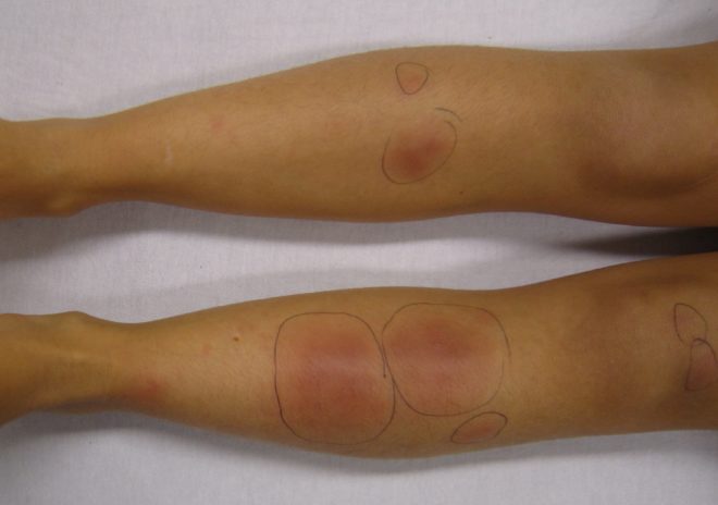 Лечение различных видов дерматита на ногах
