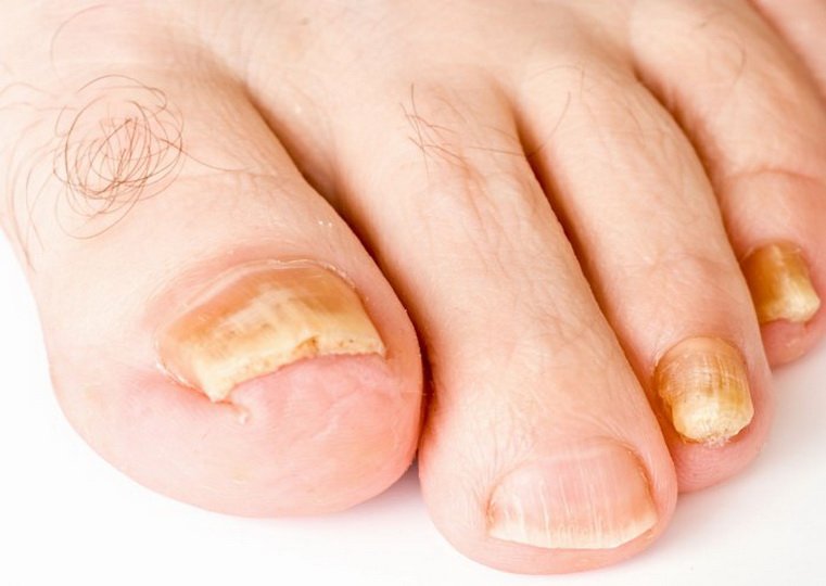 Применение медного купороса при грибке ногтей на ногах